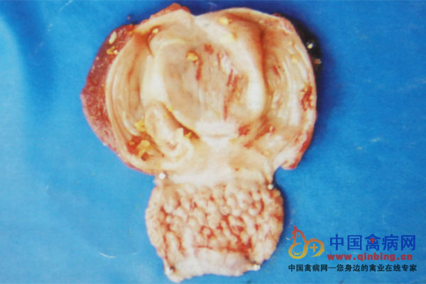 感染禽流感病鸡腺胃肿胀，乳头基部出血